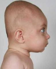 Brachycephaly