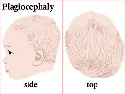 Plagiocephaly