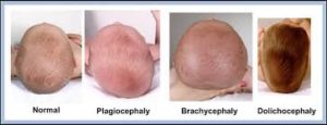 What are the causes a flat head syndrome