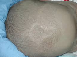 Fontanelles/ baby soft spot front of head