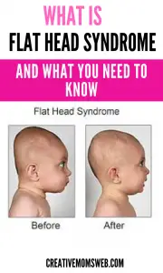 what is flat head syndrome